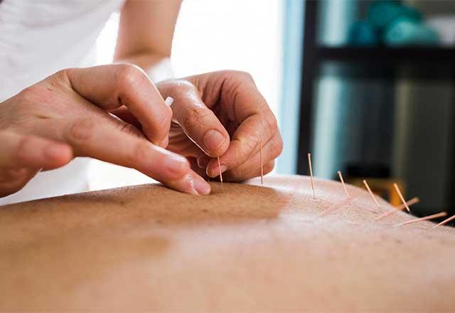 Woman at an acupuncture appointment.