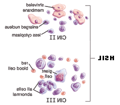 Illustration of HSIL cells.