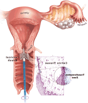 Illustration of cervical pap test.