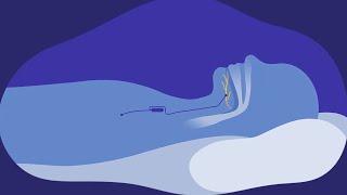 Hypoglossal Nerve Stimulation for Obstructive Sleep Apnea  Davids Story
